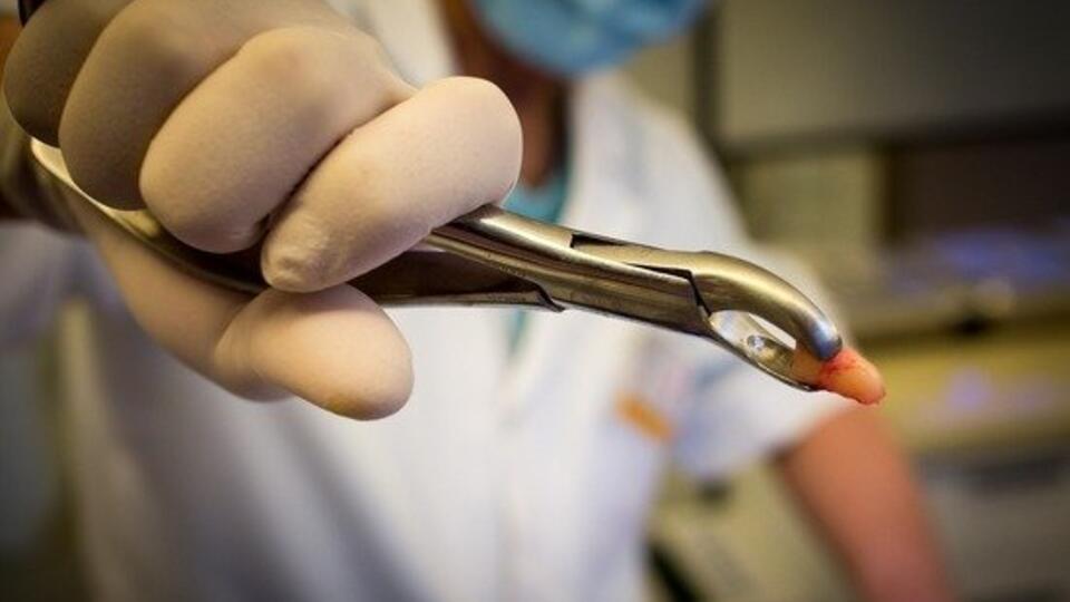Испугавшийся стоматолога мужчина вырвал себе зуб плоскогубцами