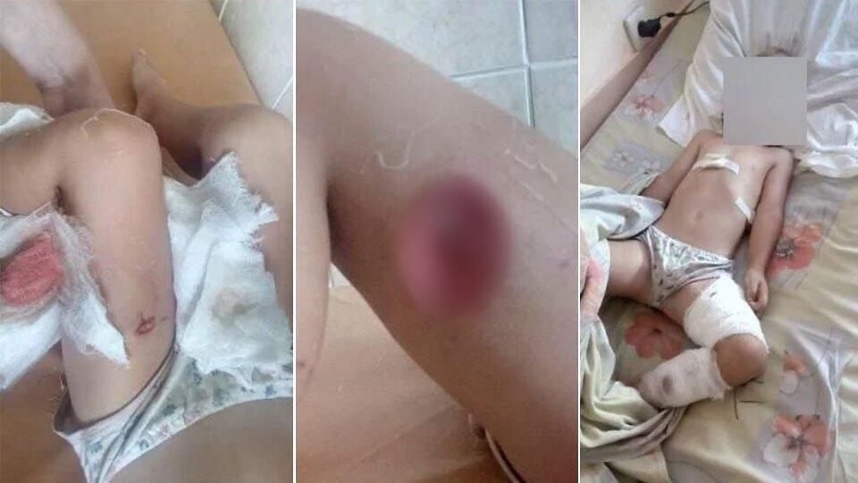 СК заинтересовался кровавым нападением алабая на ребенка в Вольске