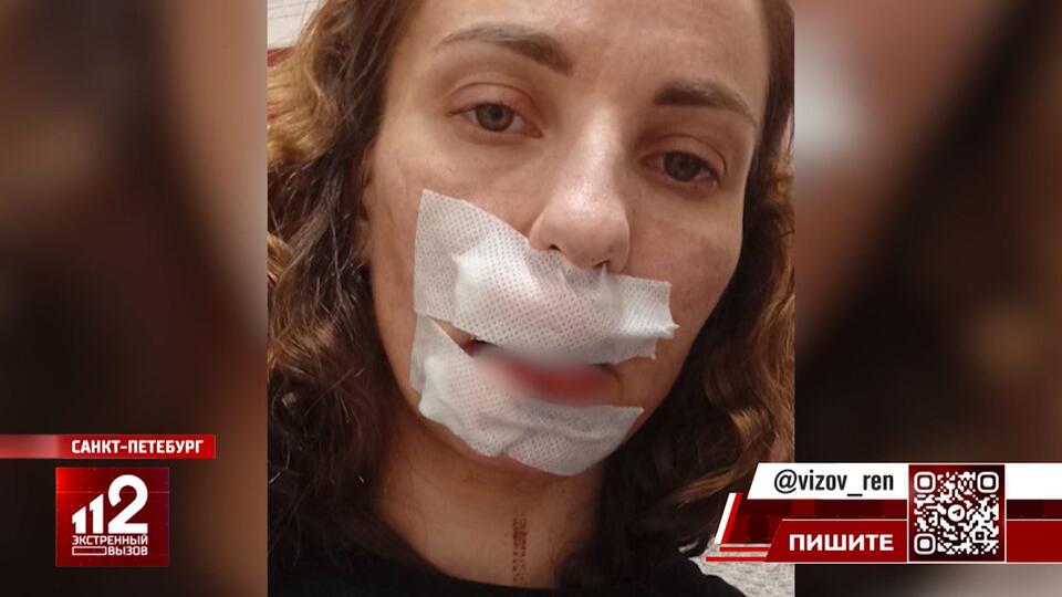 Петербурженка едва не лишилась лица после нападения собаки