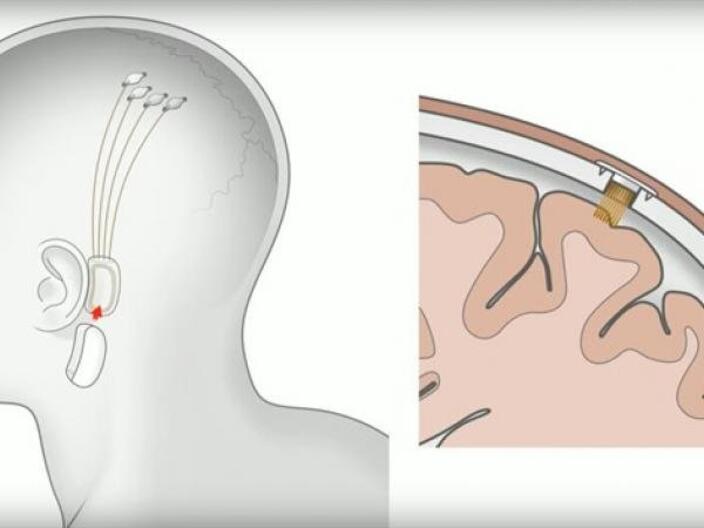 Компания Илона Маска Neuralink впервые вживила нейрочип в мозг человека (иллюстрация)